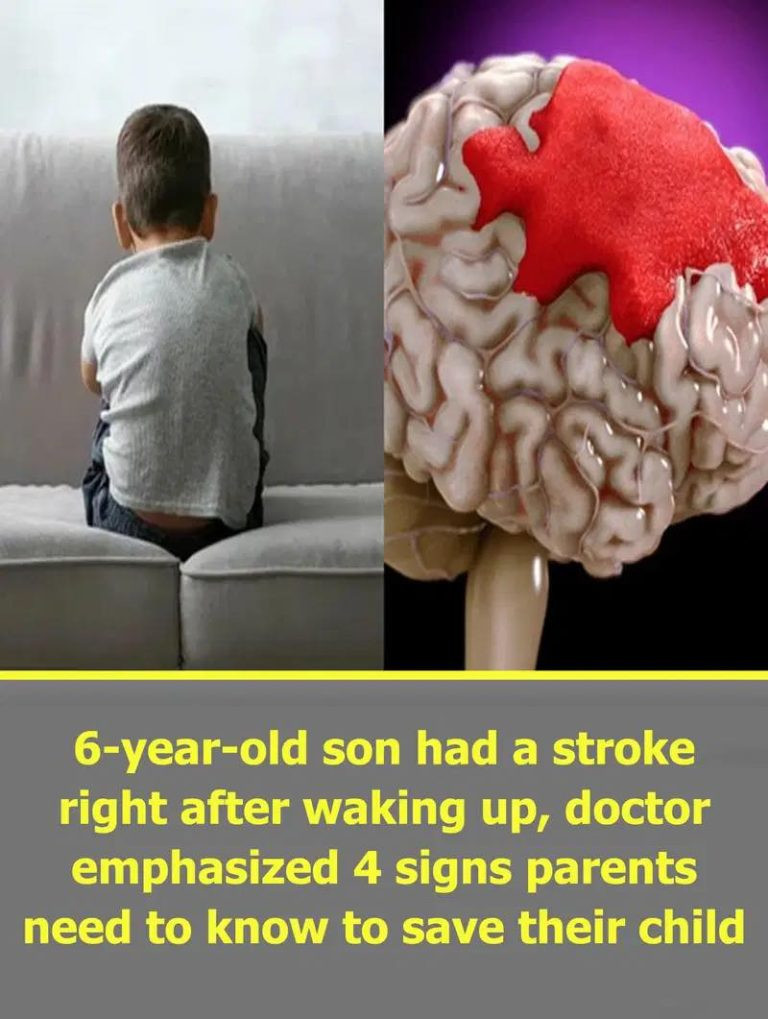 6-year-old son had a stroke right after waking up, doctor emphasized 4 signs parents need to know to save their child