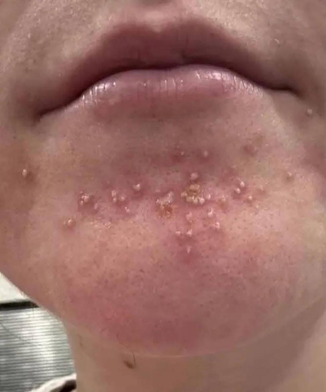 The chin button: a hidden message from your body?