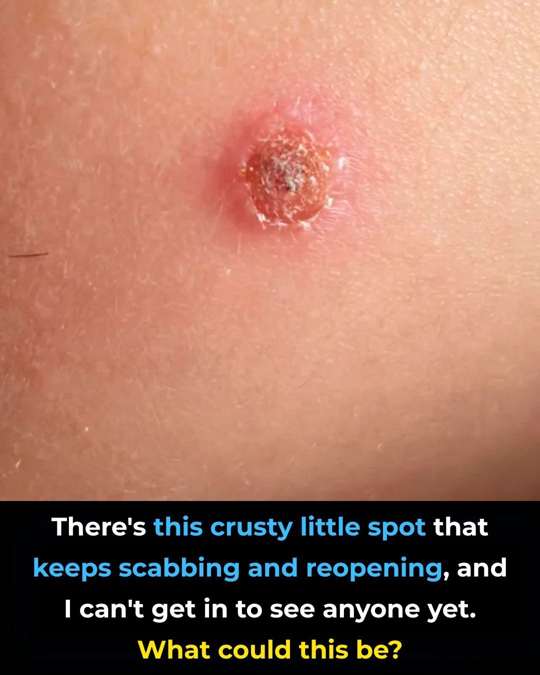 There’s this crusty little spot that keeps scabbing and reopening, and I can’t get in to see anyone yet. What could this be?
