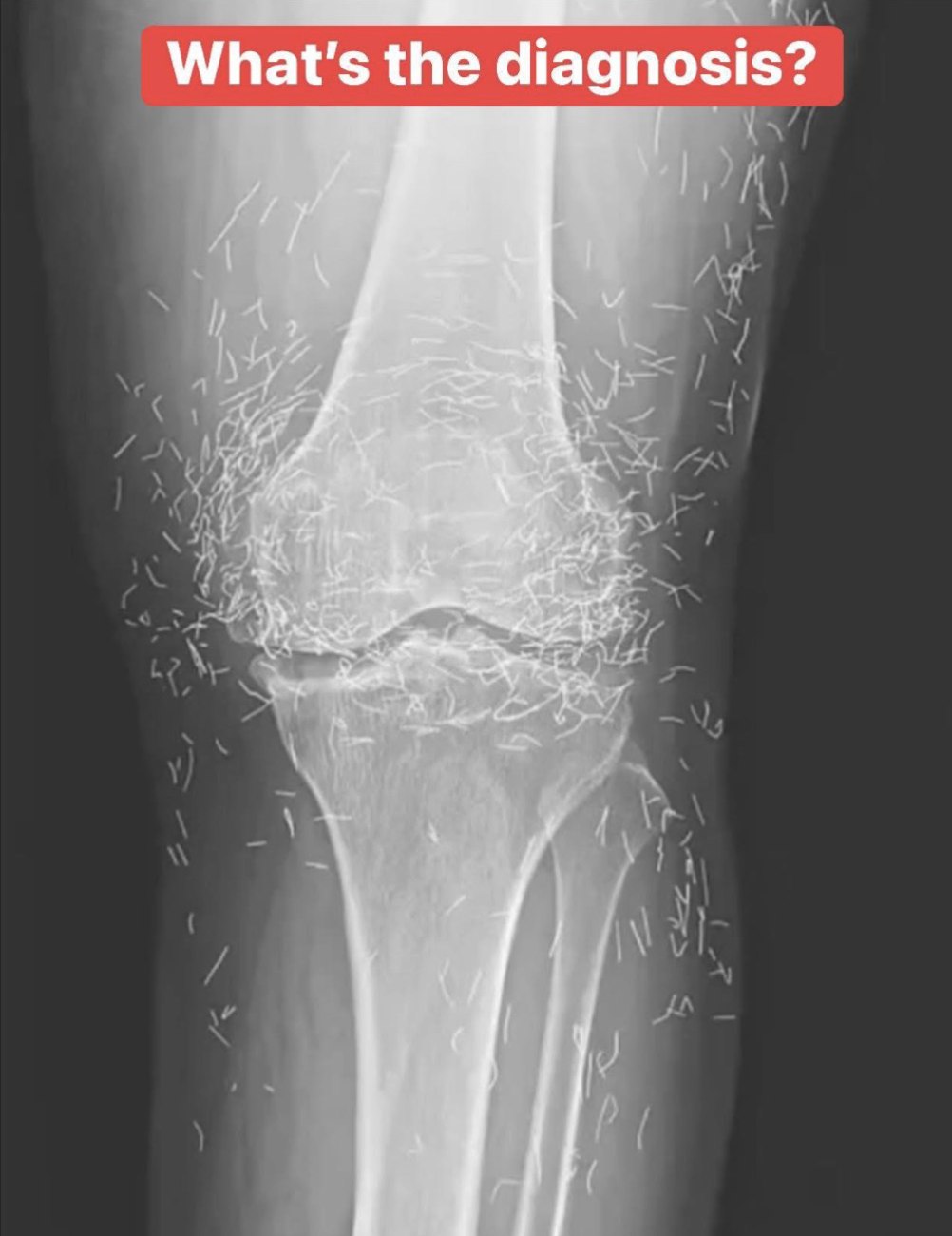 Doctors find “gold mine” in woman’s knees